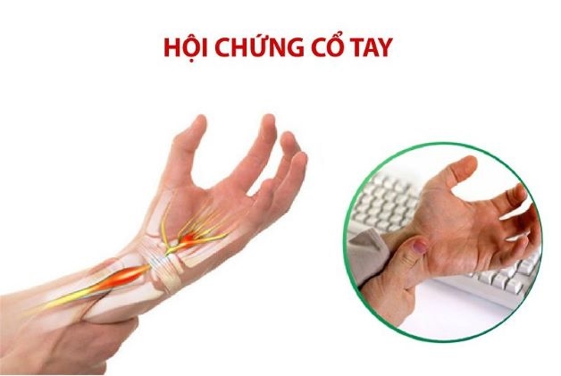 biểu hiện của hội chứng đường hầm cổ tay