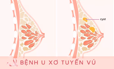 Mổ u xơ vú: Khi nào cần mổ và bằng phương pháp nào?