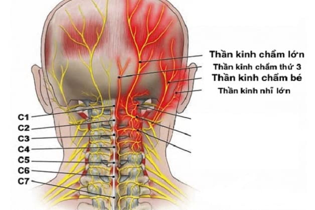 Đau dây thần kinh chẩm có thể là nguyên nhân gây đau nửa đầu bên trái