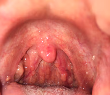 Hình ảnh viêm họng hạt mạn tính và cách nhận biết