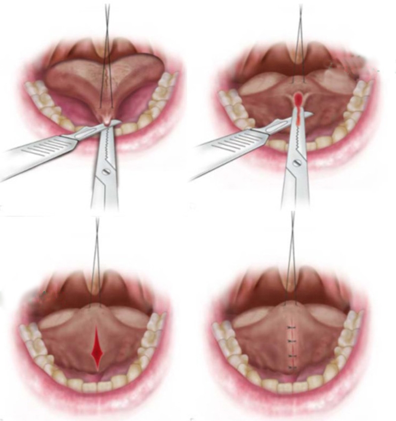 Mô tả phẫu thuật cắt thắng lưỡi