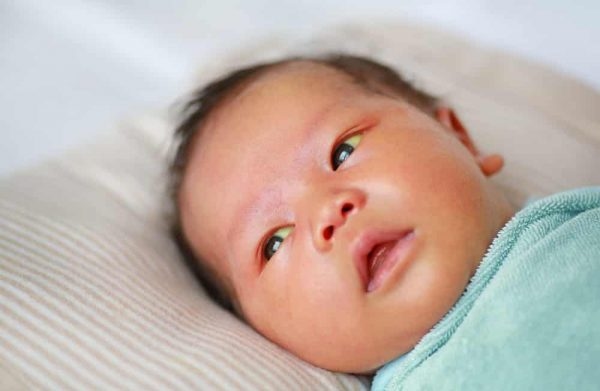 Nguyên nhân vàng da ở trẻ sơ sinh