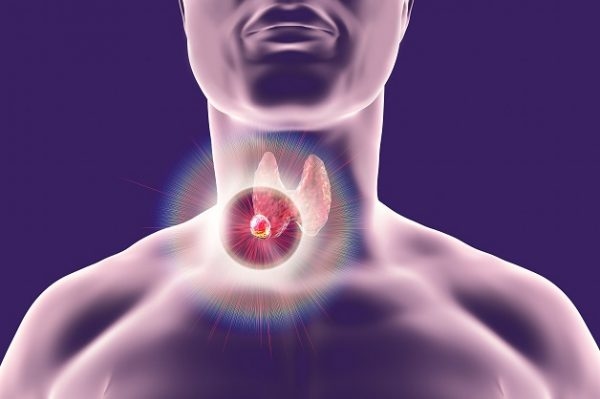 U tuyến giáp ác tính có thể chữa khỏi hoàn toàn nếu được phát hiện sớm và điều trị đúng cách