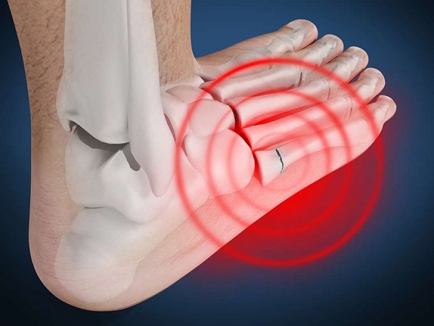 Viêm khớp bàn chân có nguy hiểm không