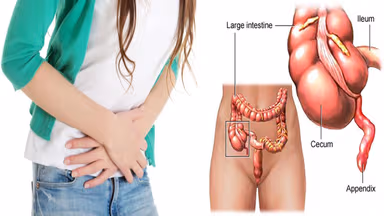 Viêm phúc mạc tiểu khung: nguyên nhân, triệu chứng và điều trị