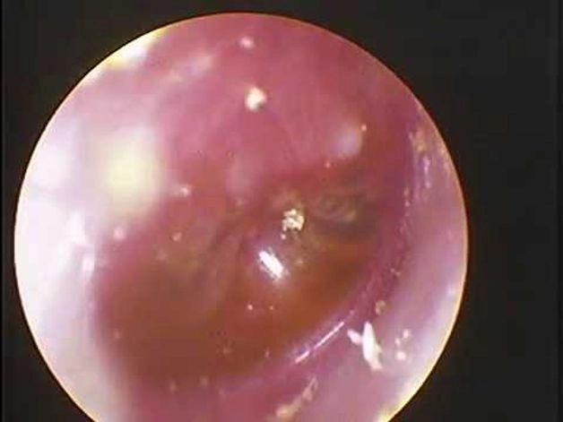 viêm tai giữa có lây không