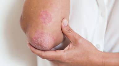 3 thông tin nhất định phải biết về viêm khớp vảy nến
