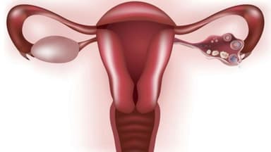 “Bật mí” cách chữa thông tắc vòi trứng hiệu quả, an toàn