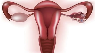 “Bật mí” cách chữa thông tắc vòi trứng hiệu quả, an toàn