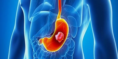 Các phương pháp điều trị ung thư dạ dày giai đoạn đầu