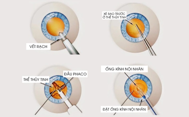 Mổ đục thủy tinh thể bằng phương pháp Phaco là phẫu thuật nhanh chóng, không đau, không chảy máu, người bệnh hoàn toàn có thể xuất viện ngay trong ngày.