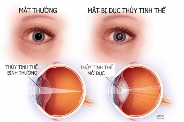 Khi thủy tinh thể bị đục, ánh sáng không thể truyền vào màng đáy mắt và người bệnh sẽ bị nhìn mờ