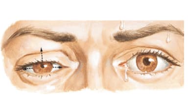 Nhược cơ là gì? Nguyên nhân, triệu chứng và cách điều trị