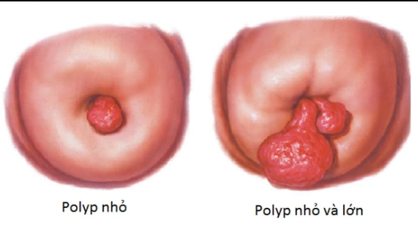 Polyp cổ tử cung gây chảy máu điều trị thế nào?
