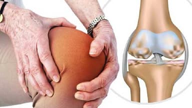 Viêm khớp đầu gối: 5 dấu hiệu cảnh báo không nên chủ quan