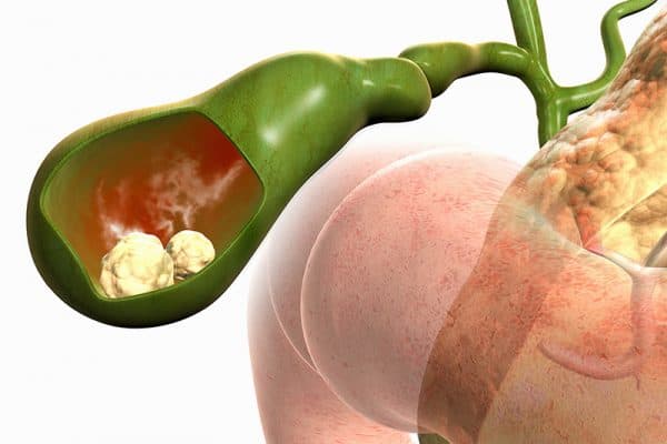 Bệnh polyp túi mật có nguy hiểm không