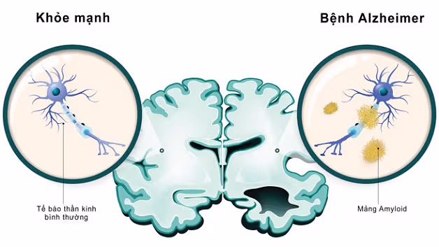 Bệnh Alzheimer có di truyền không