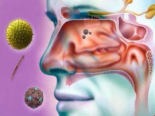 Các loại nấm và vi khuẩn này xâm nhập và phát triển trong các xoang, làm tổn thương tế bào lông chuyển ở niêm mạc xoang