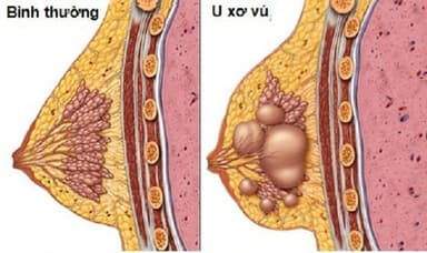 Chọc hút tế bào khối u vú: Những điều cần biết!