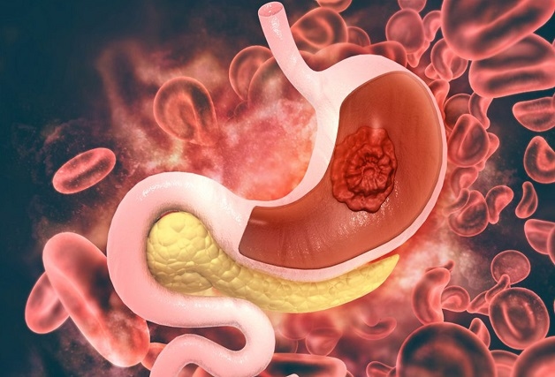 Điều trị ung thư giai đoạn cuối di căn