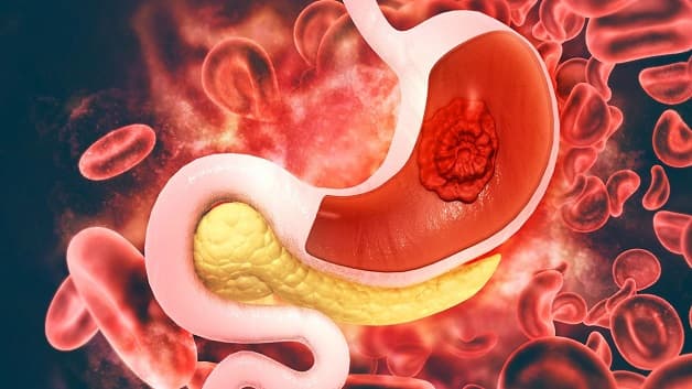 tìm hiểu điều trị ung thư dạ dày tại Singapore