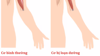 Giúp bạn hiểu rõ về bệnh loạn dưỡng cơ tiến triển