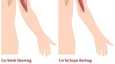 Giúp bạn hiểu rõ về bệnh loạn dưỡng cơ tiến triển