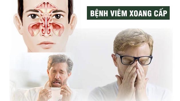 viêm xoang mũi cấp là gì