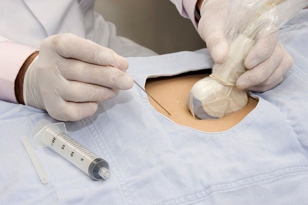 Hướng dẫn chẩn đoán và điều trị ung thư gan bằng sinh thiết