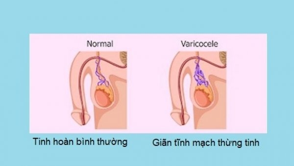 Giãn tĩnh mạch thừng tinh là hiện tượng đám rối tĩnh mạch ở trong bìu bị giãn nỡ do chịu áp lực lớn.