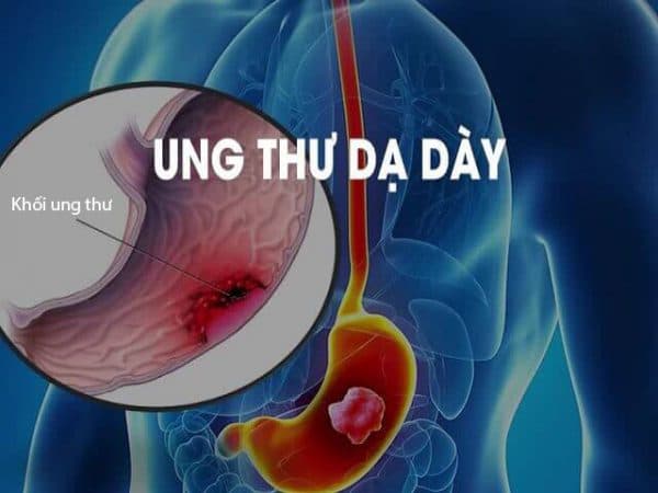 nguyên nhân và dấu hiệu ung thư dạ dày