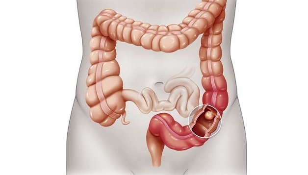 Nhận biết dấu hiệu ung thư đại tràng như thế nào