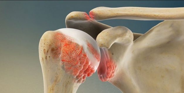 Phẫu thuật thay khớp vai được thực hiện ra sao?