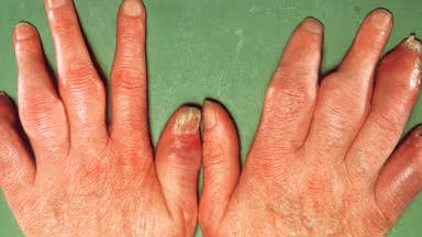 Viêm khớp vảy nến với 9 triệu chứng thường gặp nhất