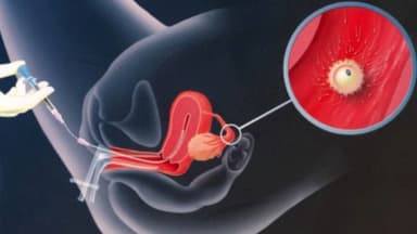 Chi phí thụ tinh nhân tạo IUI một ca hết bao nhiêu?