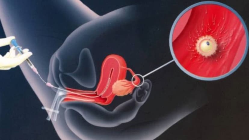 Chi phí thụ tinh nhân tạo IUI một ca hết bao nhiêu?