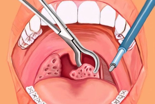 viêm amidan hốc mủ bã đậu có nguy hiểm không