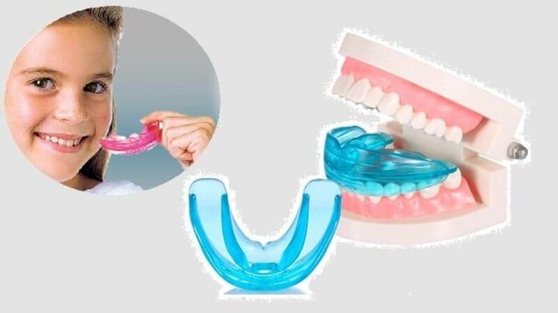Nắn chỉnh răng cho trẻ em bằng hàm trainer được nhiều bậc phụ huynh quan tâm
