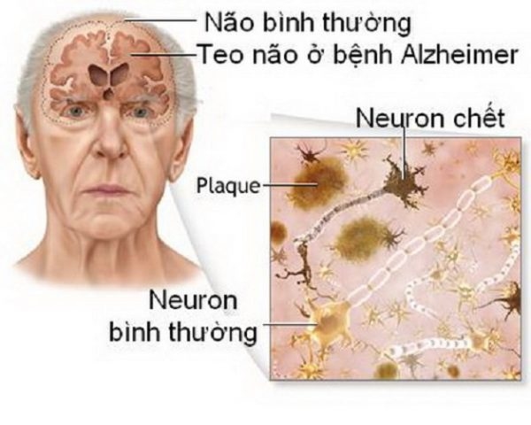 sa sút trí tuệ ở người cao tuổi nguy hiểm thế nào