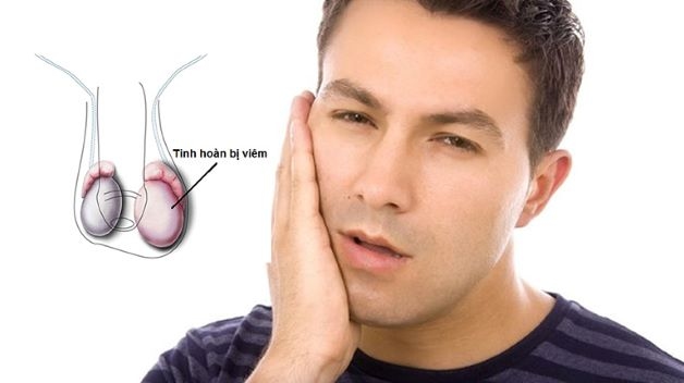 Quai bị viêm tinh hoàn hay còn gọi là viêm tinh hoàn quai bị Orchite Ourlienne, đây là biến chứng nguy hiểm của bệnh quai bị.