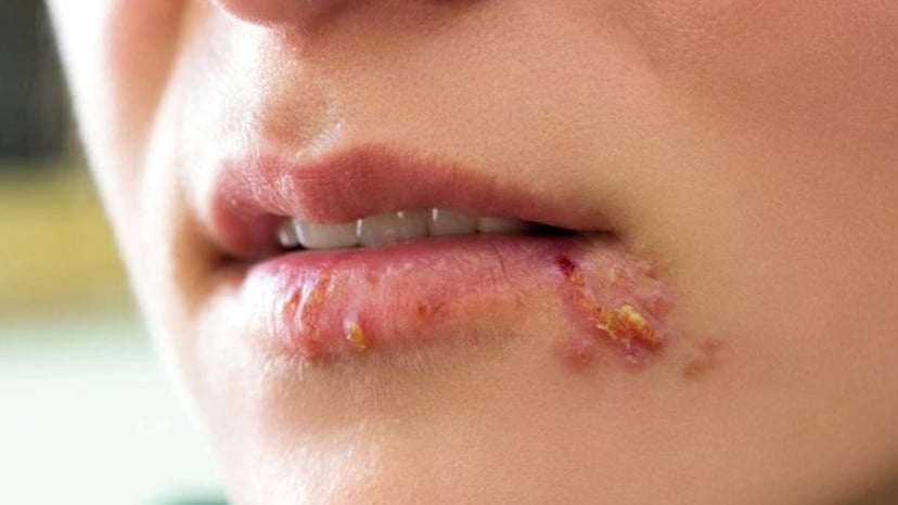 Hình ảnh mụn rộp sinh dục ở nữ giới và dấu hiệu nhận biết