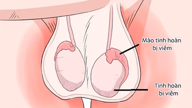 Khi bị viêm tinh hoàn khám ở đâu uy tín, chất lượng tốt nhất
