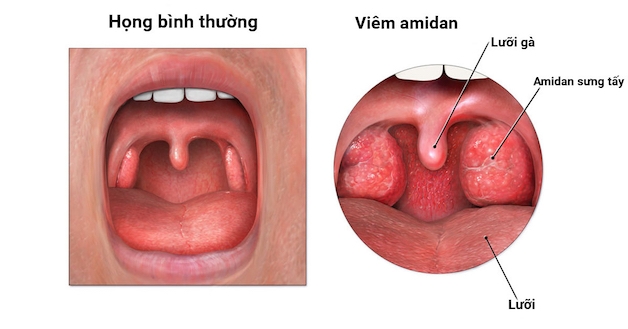 thế nào là bị viêm amidan
