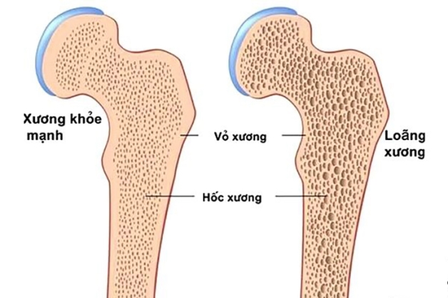 cách phát hiện bệnh loãng xương