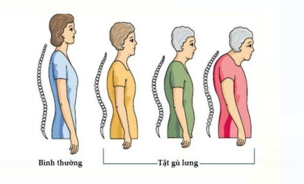 bệnh loãng xương có chữa được không