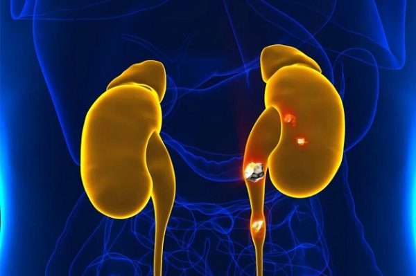 Bạn có biết cách điều trị sỏi thận