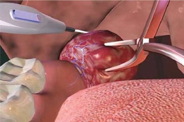 Có nhất thiết cắt amidan cho trẻ hay không?