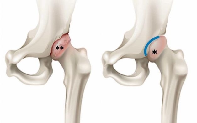 tìm hiểu về bệnh viêm khớp háng ở trẻ em