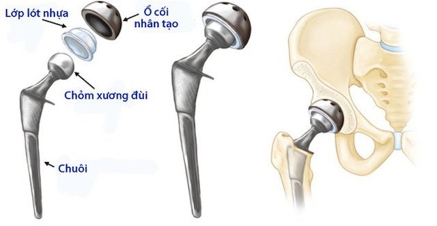 mổ thay xương khớp háng có đắt không