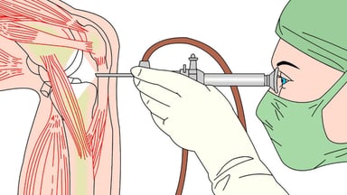 Giải đáp: Thay khớp gối có đi lại bình thường được không?